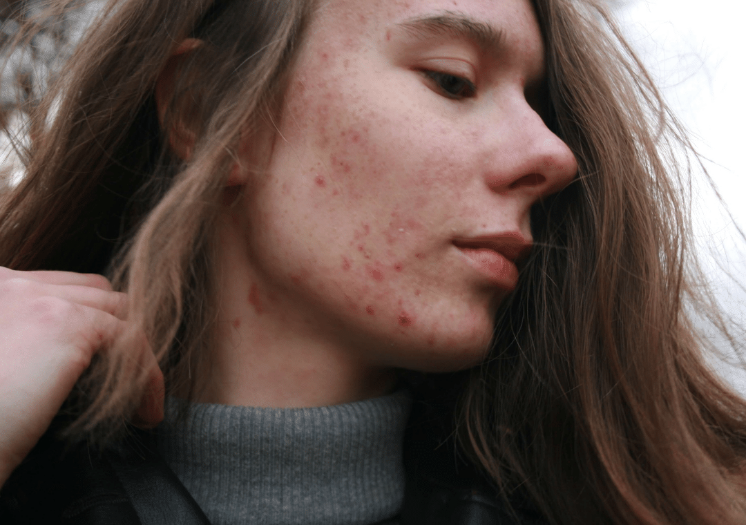 Problem Acne? Could Be Hormonal Imbalances from PCOS