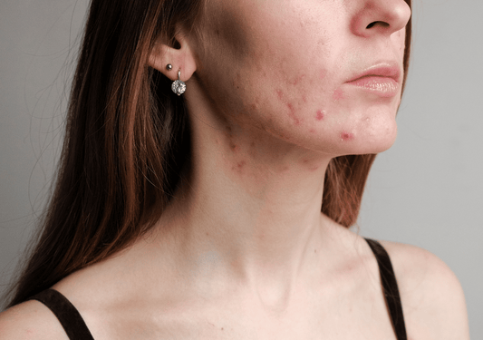 Gut-Related Acne: Could Your Gut Be the Cause Behind Your Breakouts?